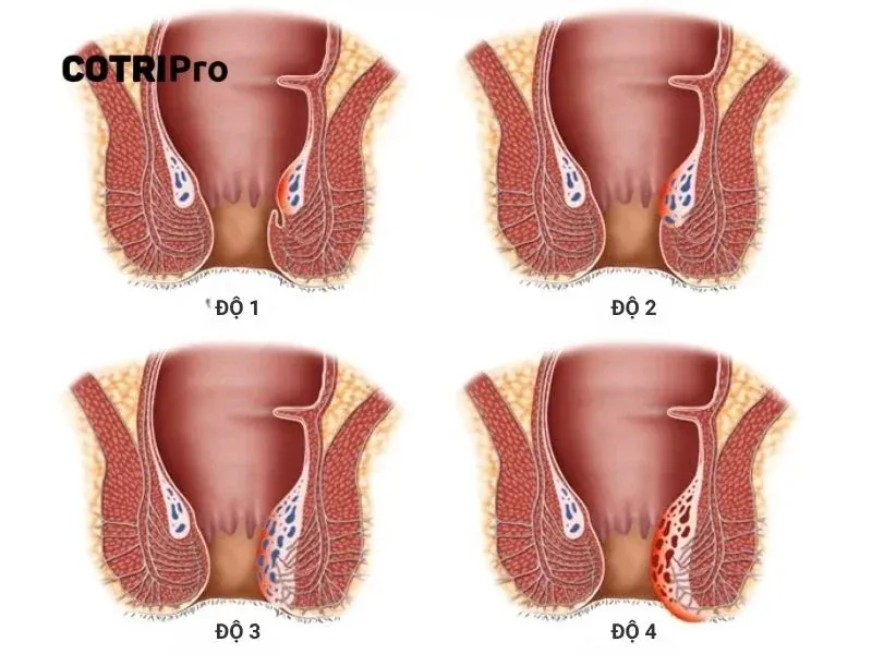 Hình Ảnh Trĩ: Tuyển Tập 100+ Ảnh Y Khoa Chân Thực · ảnh 2