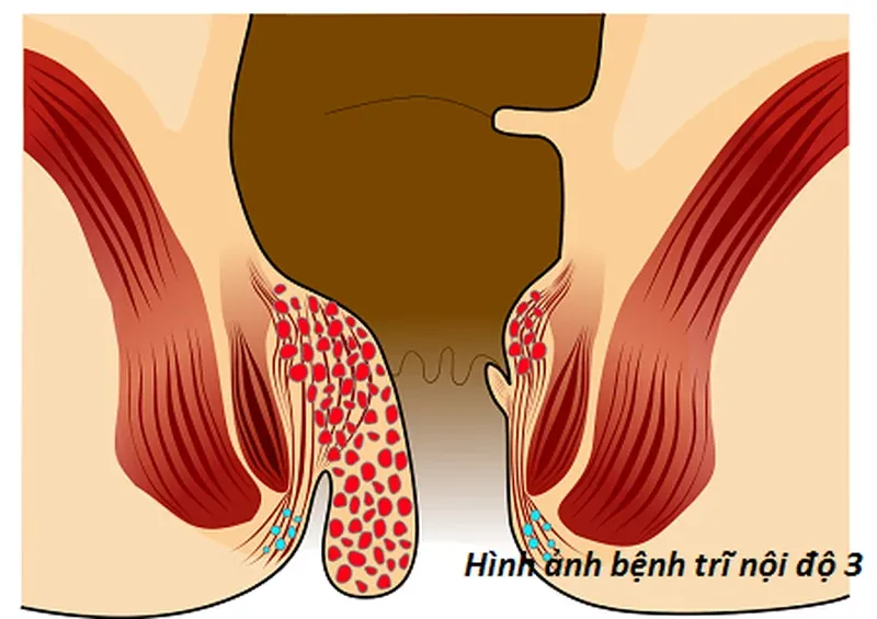 Hình Ảnh Trĩ: Tuyển Tập 100+ Ảnh Y Khoa Chân Thực · ảnh 3